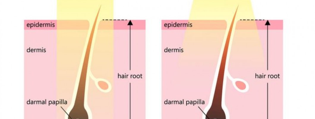 IPL lazer mi daha iyi, Diode lazer mi?